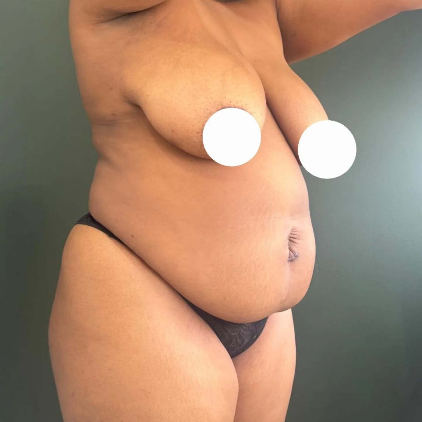 Mommy Makeover Reduction and Tummy Tuck Before